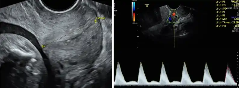 Transvaginal Scan
